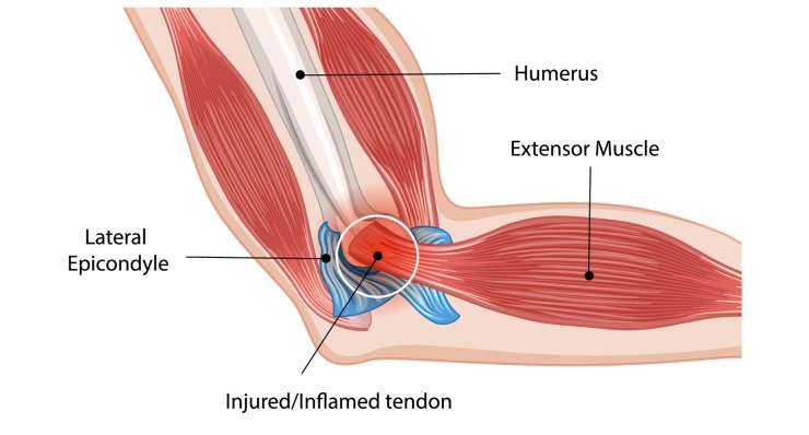 Epicondylitis Golferellenbogen oder Tennisellenbogen Epicondylitis Golferellenbogen oder Tennisellenbogen. Behandlung in München durch Prof. Dr. med. Martetschläger