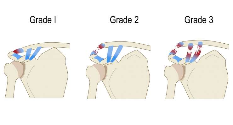 AC-Gelenksluxation AC-Gelenksluxation - Verletzung des Schultereckgelenks. Behandlung in München durch Prof. Dr. med. Martetschläger