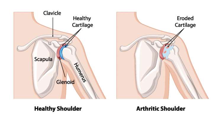 Arthrose ACG Arthrose ACG - Knorpelverschleiß im Schultereckgelenk. Behandlung in München durch Prof. Dr. med. Martetschläger