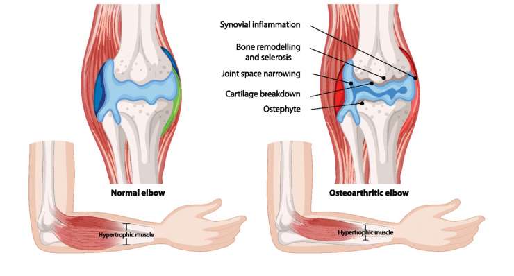 Ellenbogenarthrose Ellenbogenarthrose - Verschleiß des Gelenkknorpels. Behandlung in München durch Prof. Dr. med. Martetschläger