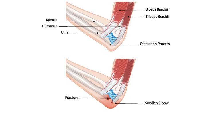 Ellenbogenbruch Ellenbogenbruch. Behandlung in München durch Prof. Dr. Med. Martetschläger