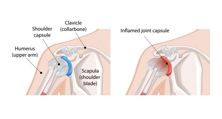 Frozen-Shoulder Frozen-Shoulder - schmerzhafte Schultersteife. Behandlung in München durch Prof. Dr. med. Martetschläger