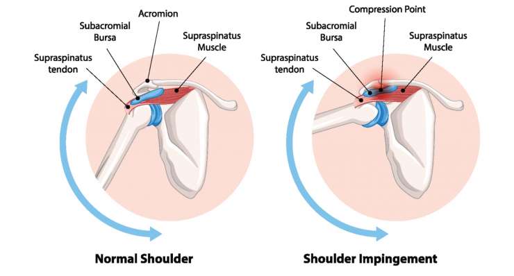 Subacromiales Impingement Subacromiales Impingement - Schmerzhaftes Engpass-Syndrom unter dem Schulterdach. Behandlung in München durch Prof. Dr. med. Martetschläger