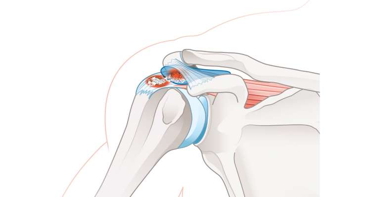 kalkschulter-prof-dr-martetschlaeger-muench