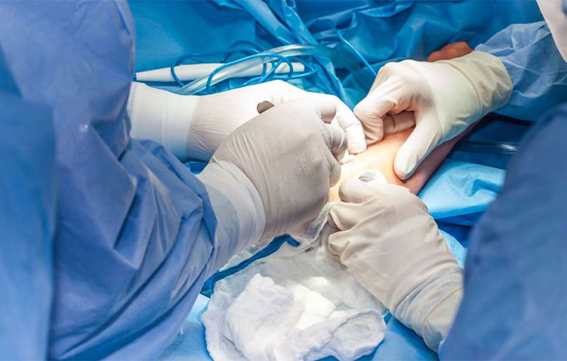 Offene Eingriffe am Ellenbogen in München - Prof. Dr. med. Martetschläger Offene Eingriffe am Ellenbogen in München - Durchgeführt von Prof. Dr. med. Martetschläger