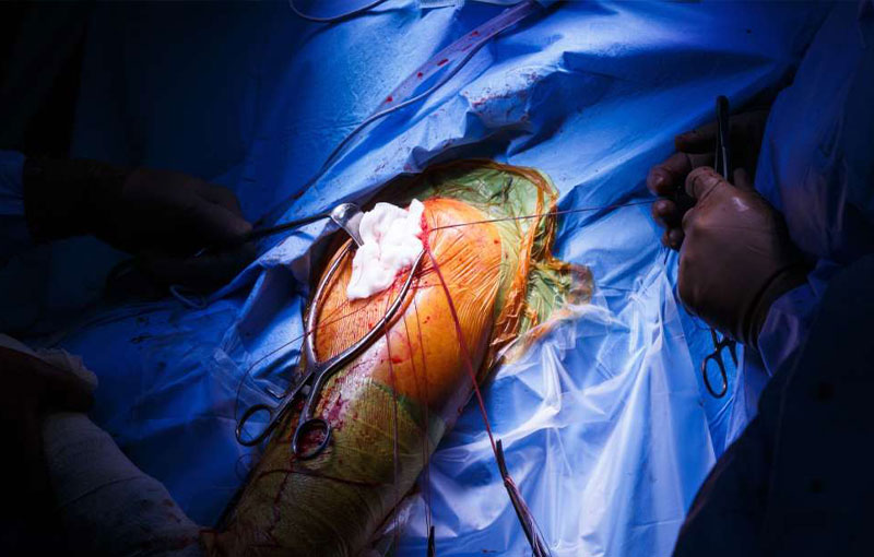 Offene und minimalinvasive Operationen an der Schulter in München - Prof. Dr. med. Martetschläger Offene und minimalinvasive Operationen an der Schulter in München - Durchgeführt von Prof. Dr. med. Martetschläger