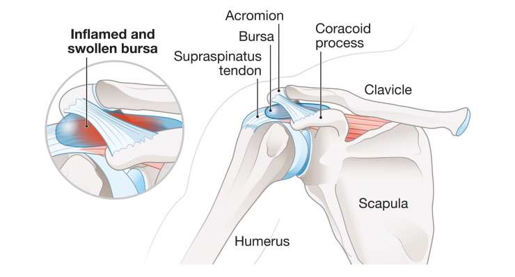 Schleimbeutelentzündung in der Schulter Schleimbeutelentzündung in der Schulter. Behandlung in München durch Prof. Dr. med. Martetschläger