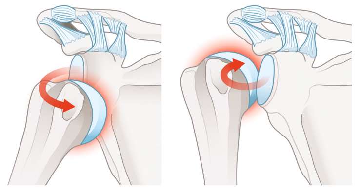 Schulterluxation Schulterluxation - Auskugeln des Oberarmkopfes aus der Gelenkpfanne. Behandlung in München durch Prof. Dr. med. Martetschläger